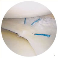 Résultat de recherche d'images pour "suture ménisque"